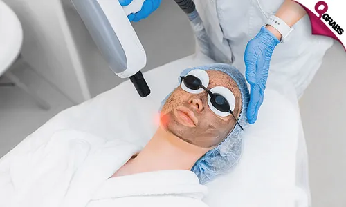 Carbon Laser Peel + Consultation for Ladies & Men!